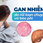 Mối liên quan giữa béo phì và ung thư 7 Gan nhiễm mỡ do rối loạn chuyển hóa và béo phì