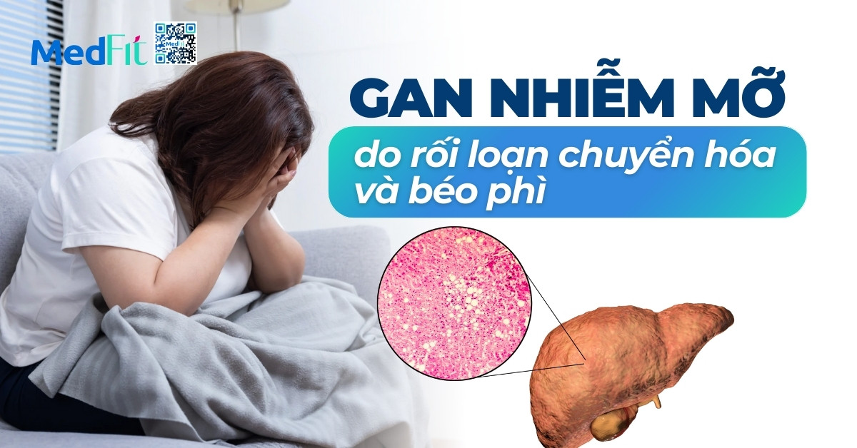 gan nhiễm mỡ do rối loạn chuyển hóa và béo phì