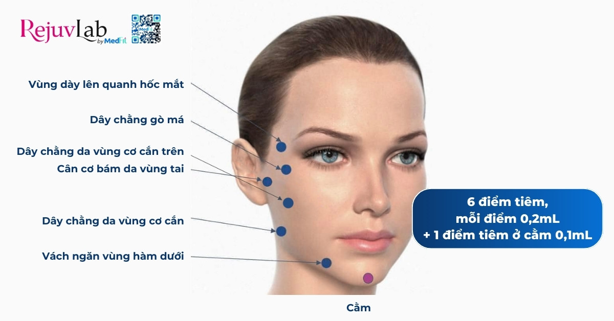 hình minh họa 6 điểm tiêm jalupro