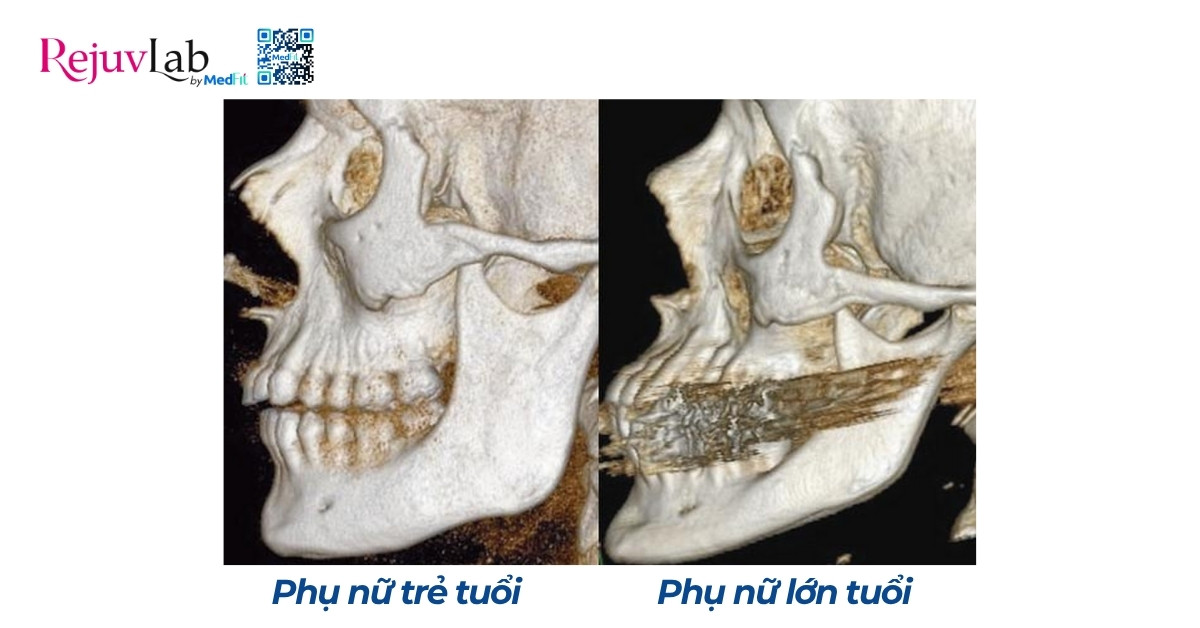 Làm sao để làm mờ rãnh mũi má? 6 hình minh hoạ cấu trúc xương ở phụ nữ trẻ tuổi và lớn tuổi