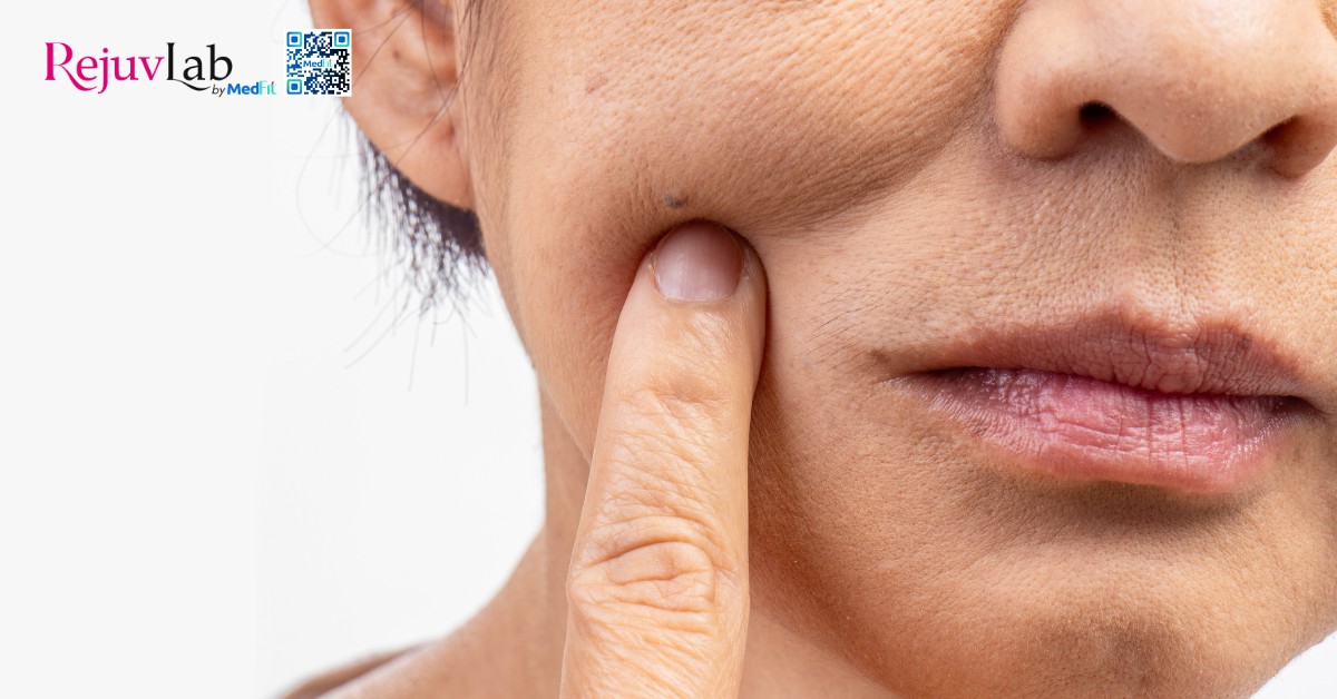 Tiêm BAP Karisma Rh Collagen - Bí quyết trẻ hóa và tái tạo da cực hot hiện nay 8 hình minh hoạ làn da lão hóa, kém sức sống
