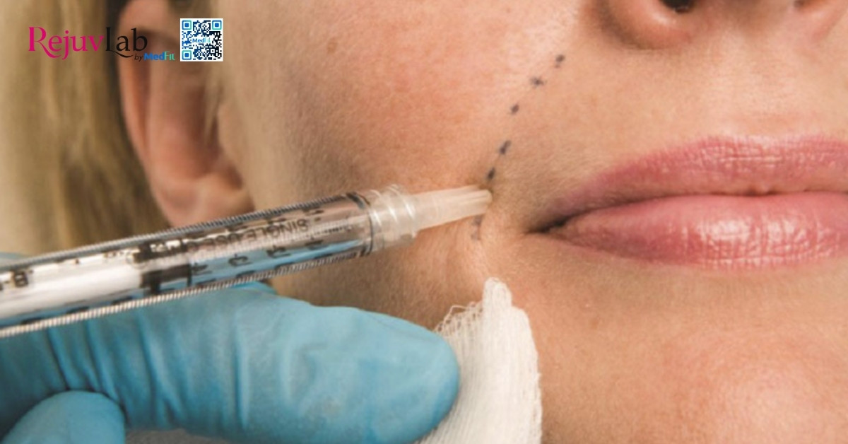 hình minh hoạ tiêm botox