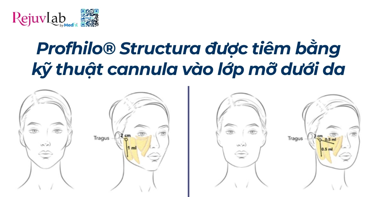 kỹ thuật tiêm profhilo structura