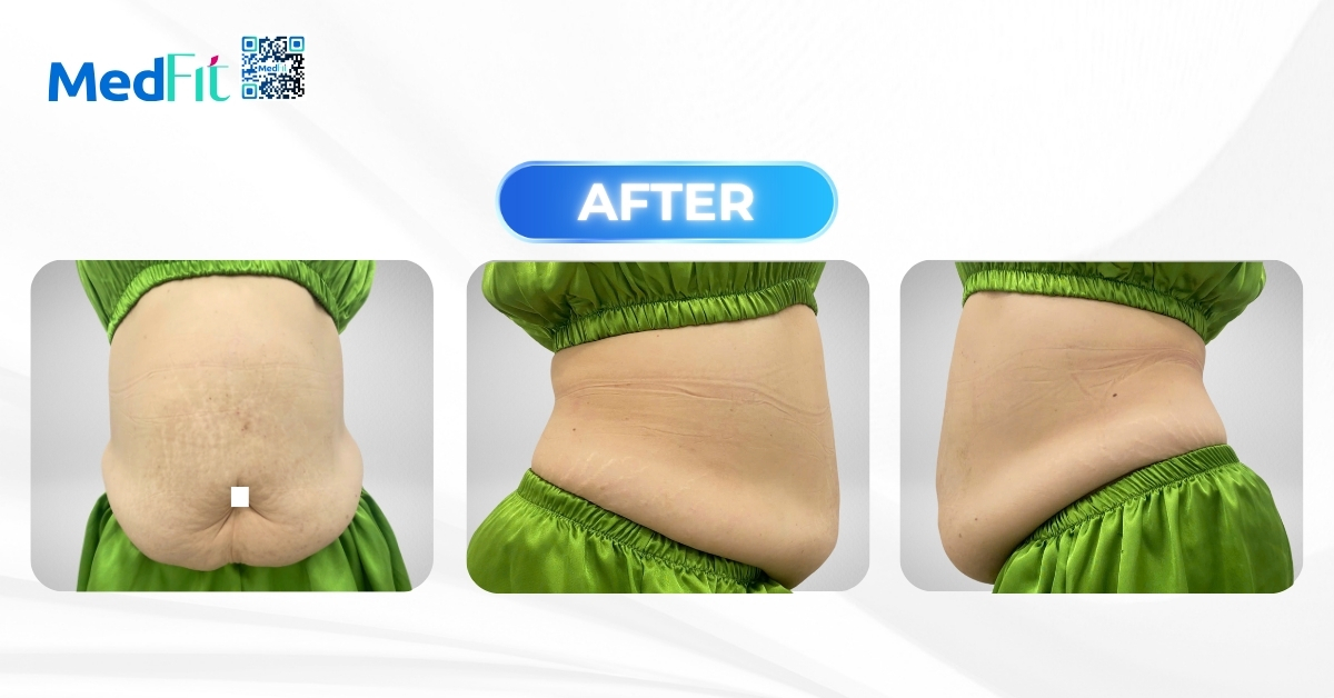 3 vòng bụng khách vh sau khi vào liệu trình