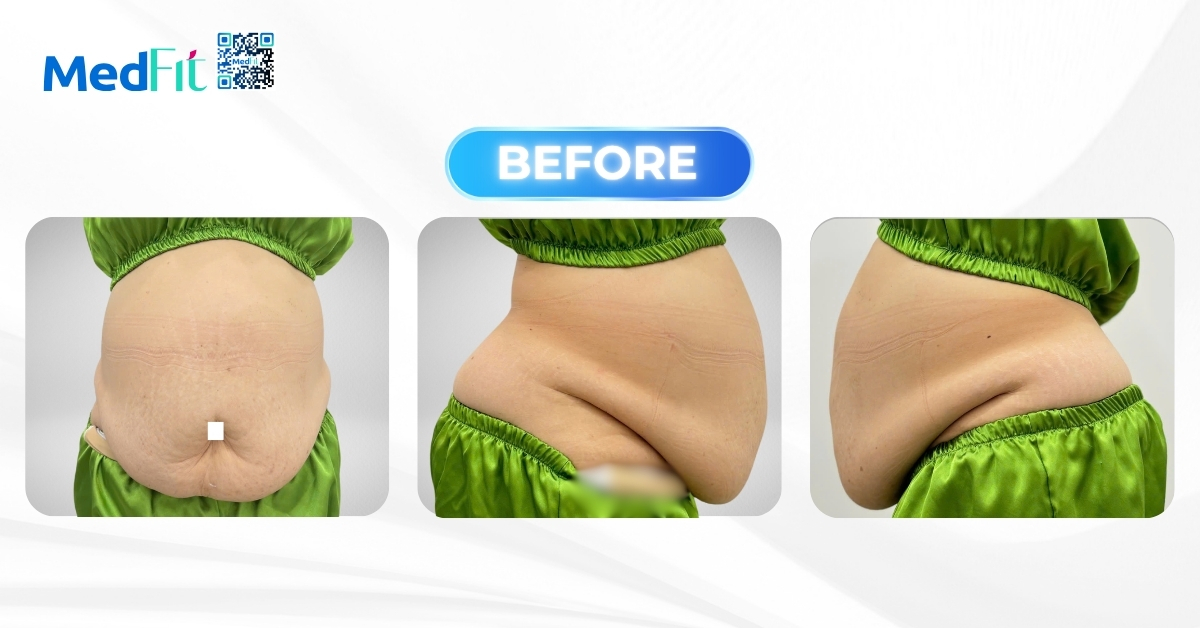 3 vòng bụng khách vh trước khi vào liệu trình