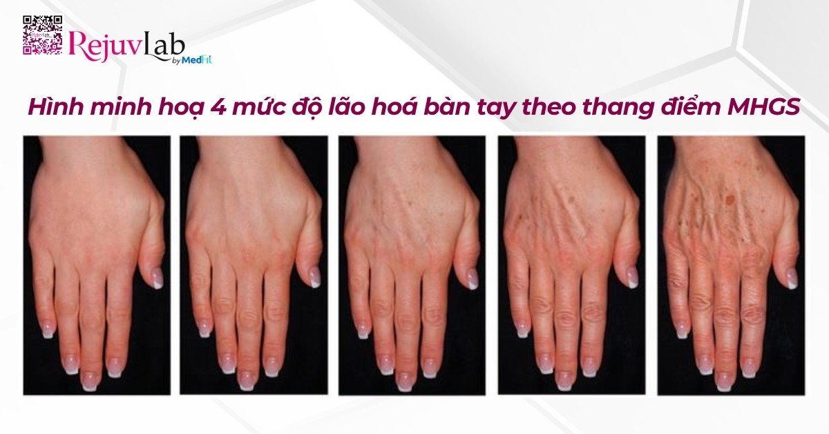 4 mức độ lão hoá bàn tay theo thang điểm mhgs