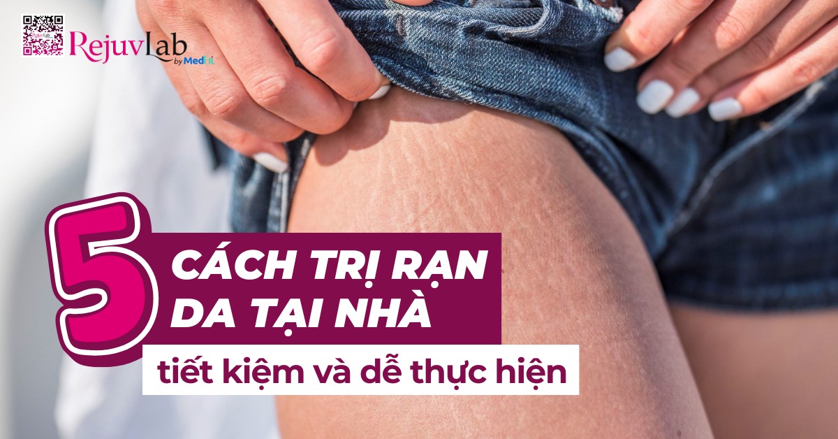 5 cách trị rạn da tại nhà tiết kiệm và dễ thực hiện