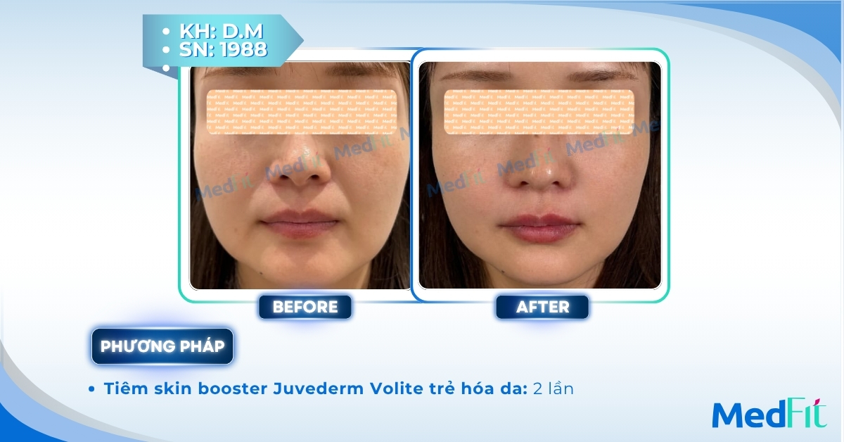 CLS Juvederm Volite