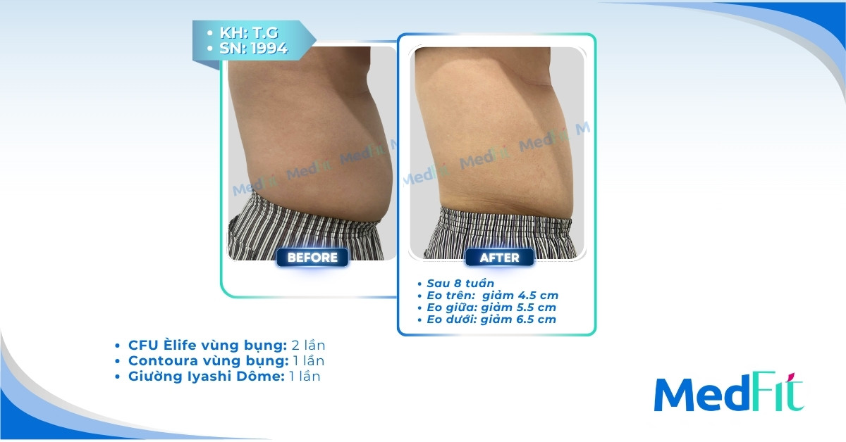 Béo bụng dưới là gì và cách điều trị 20 Béo bụng dưới là gì và cách điều trị 19
