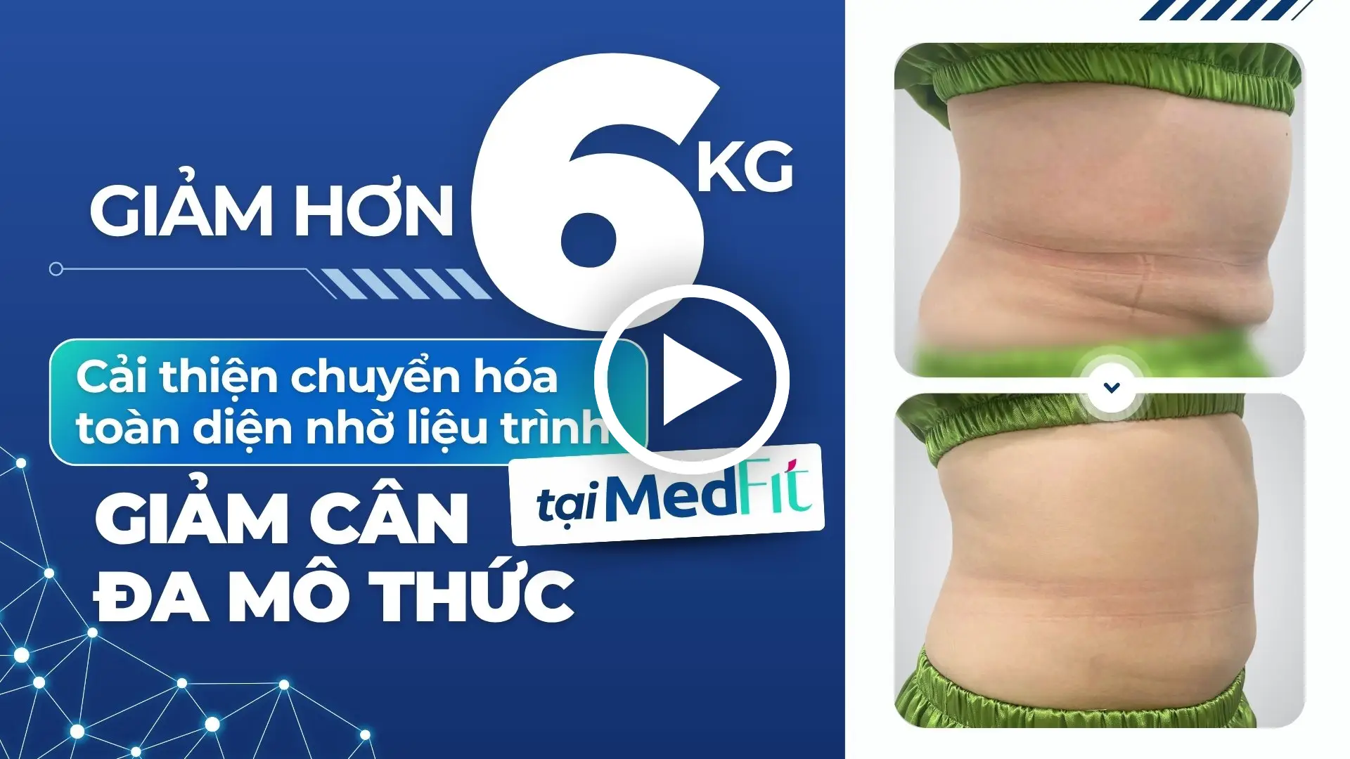 Giảm hơn 6kg- cải thiện chuyển hóa toàn diện nhờ liệu trình GCĐMT
