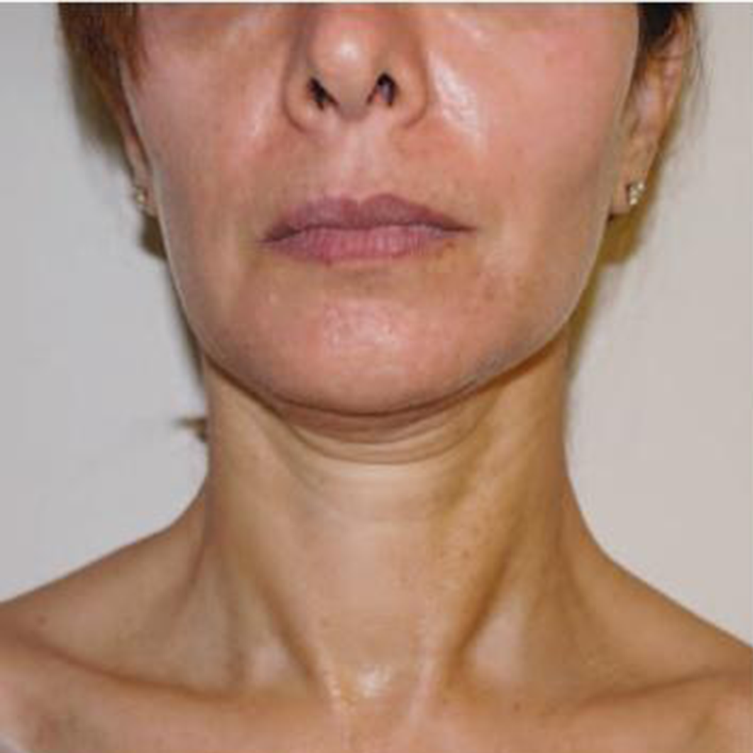 Nghiên cứu lâm sàng restylane 1