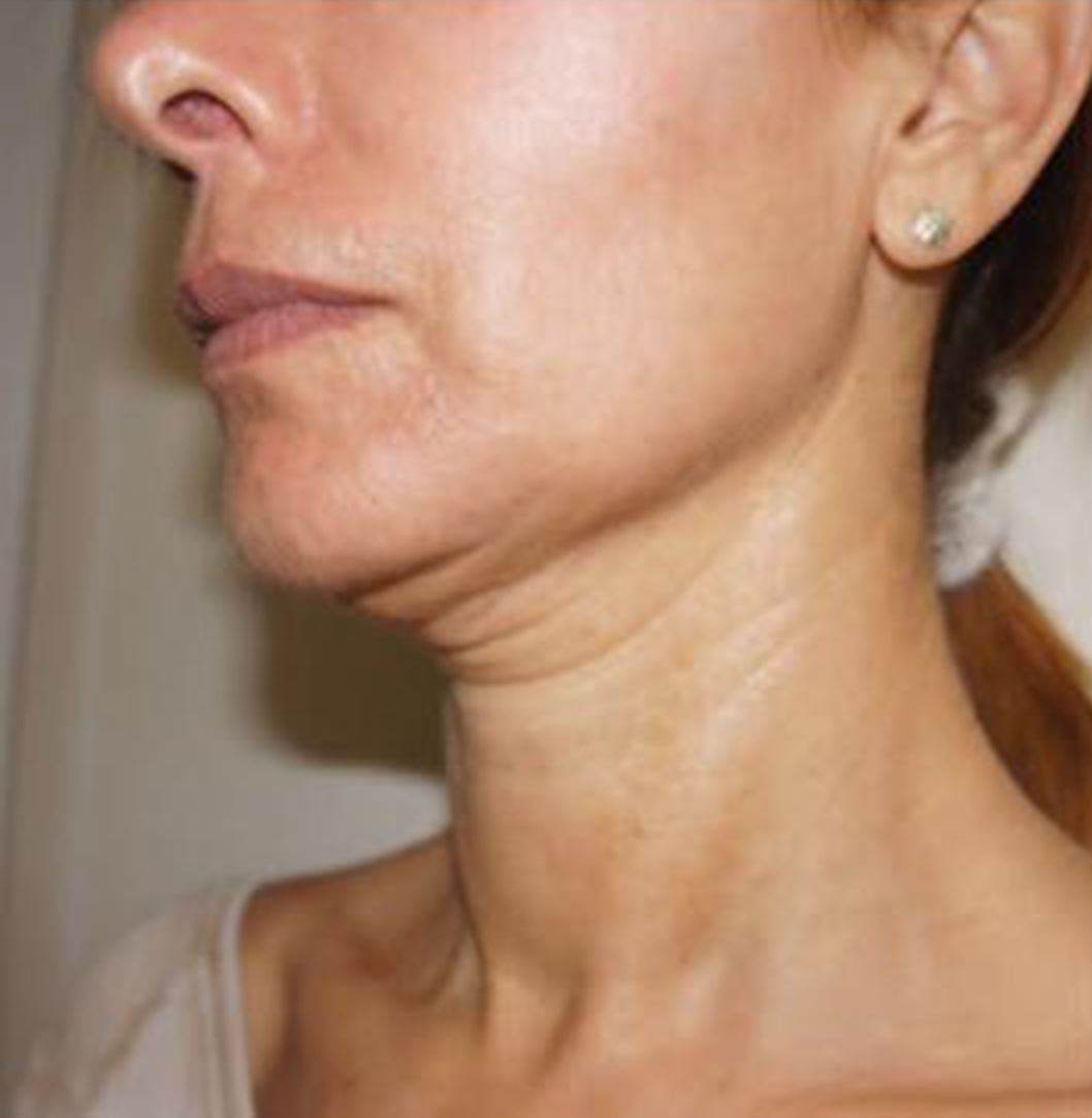 Nghiên cứu lâm sàng restylane 3