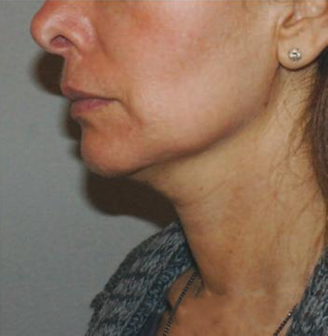 Nghiên cứu lâm sàng restylane 4