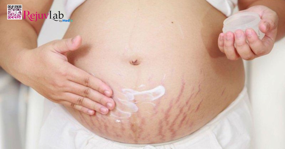 bà bầu bị rạn da màu đỏ bôi kem