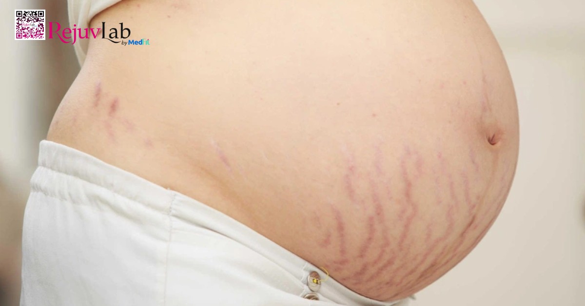 bà bầu bị rạn da màu đỏ