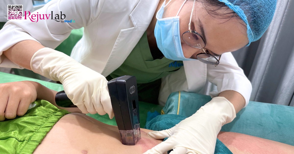 bác sĩ thực hiện morpheus8 trị rạn da tại rejuvlab