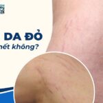 Bị rạn da đỏ có thể tự hết không?