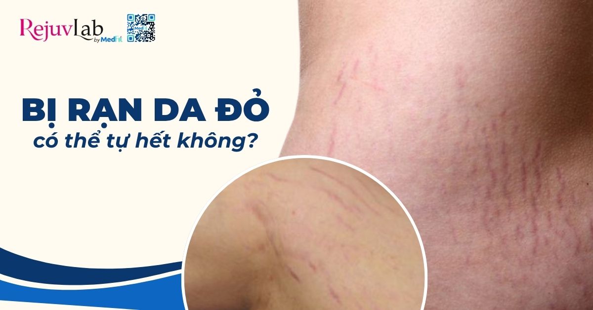 bị rạn da đỏ có thể tự hết không