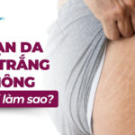 Nguyên nhân bị rạn da ở mông và cách xử lý hiệu quả 12 Bị rạn da màu trắng ở mông thì phải làm sao?