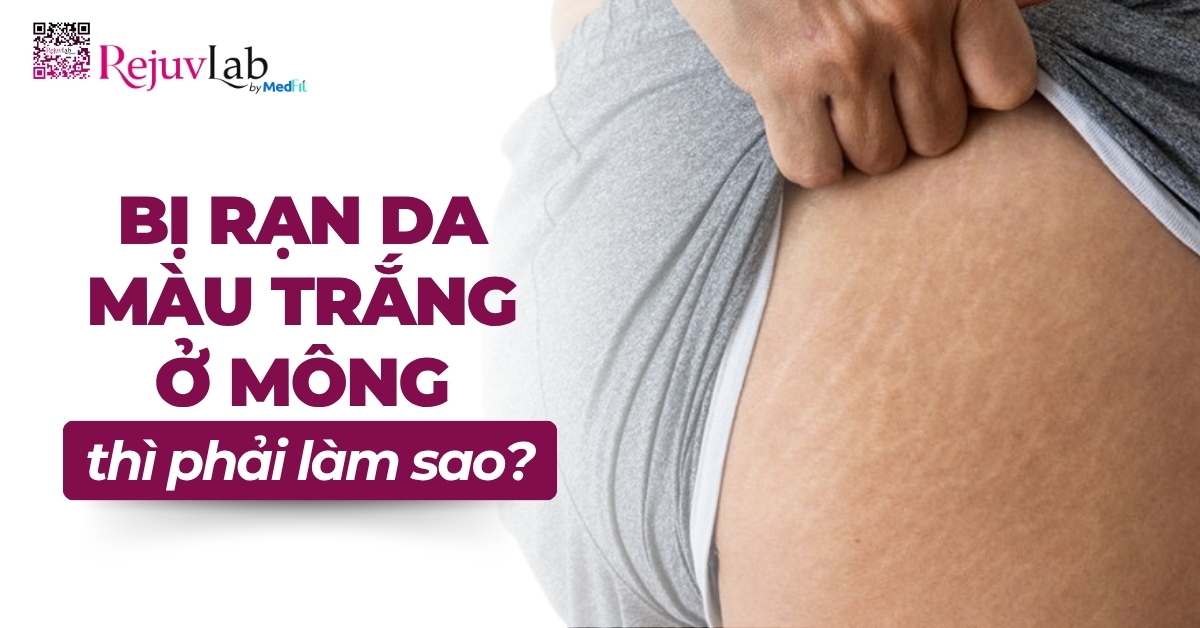 bị rạn da màu trắng ở mông thì phải làm sao