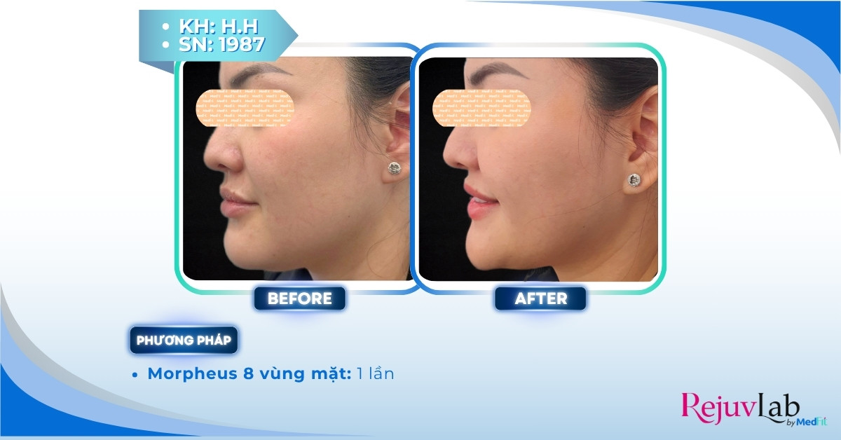 Các cách giảm mỡ mặt hiệu quả 9 ca lâm sàng giảm mỡ mặt bằng morpheus8 tại medfit