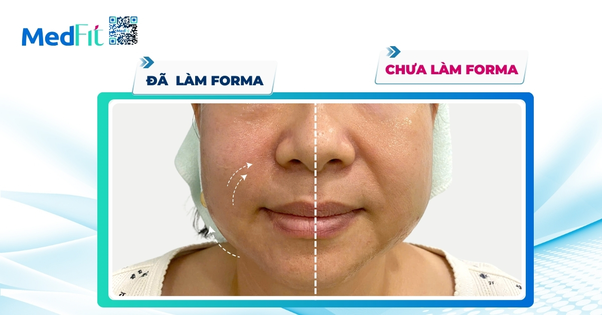 ca lâm sàng làm mờ nếp nhăn mũi má bằng Forma tại MedFit