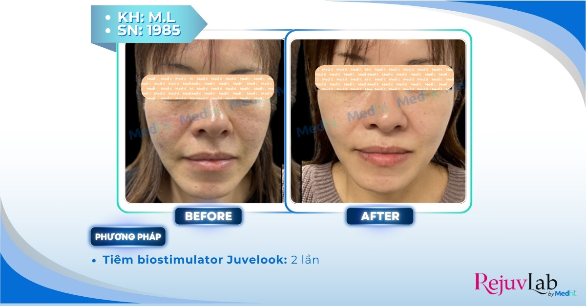 Tất cả những gì bạn cần biết về skin booster trong trẻ hóa và tái tạo làn da 12 ca lâm sàng tiêm juvelook tại medfit