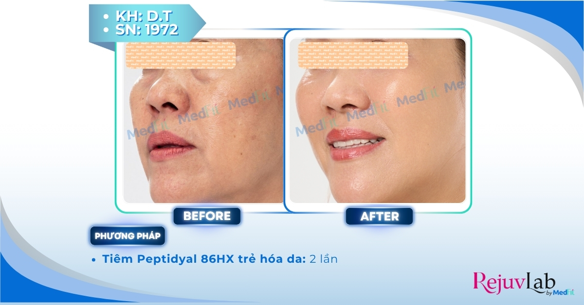 Peptidyal 86HX – Công thức phục hồi và tái tạo làn da tiên tiến 5 ca lâm sàng tiêm peptidyal tại medfit
