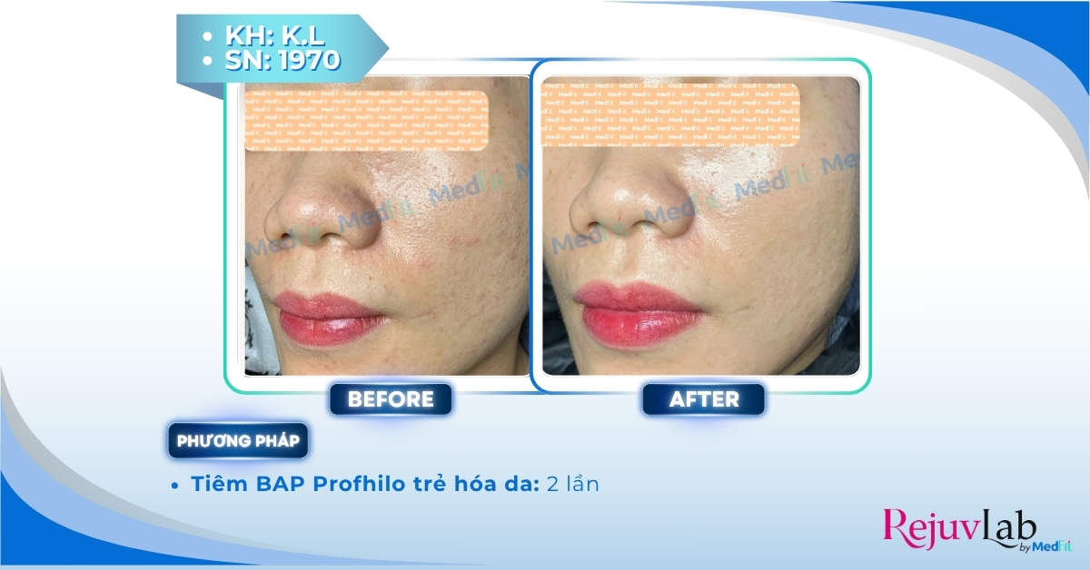 ca lâm sàng tiêm profhilo tại medfit