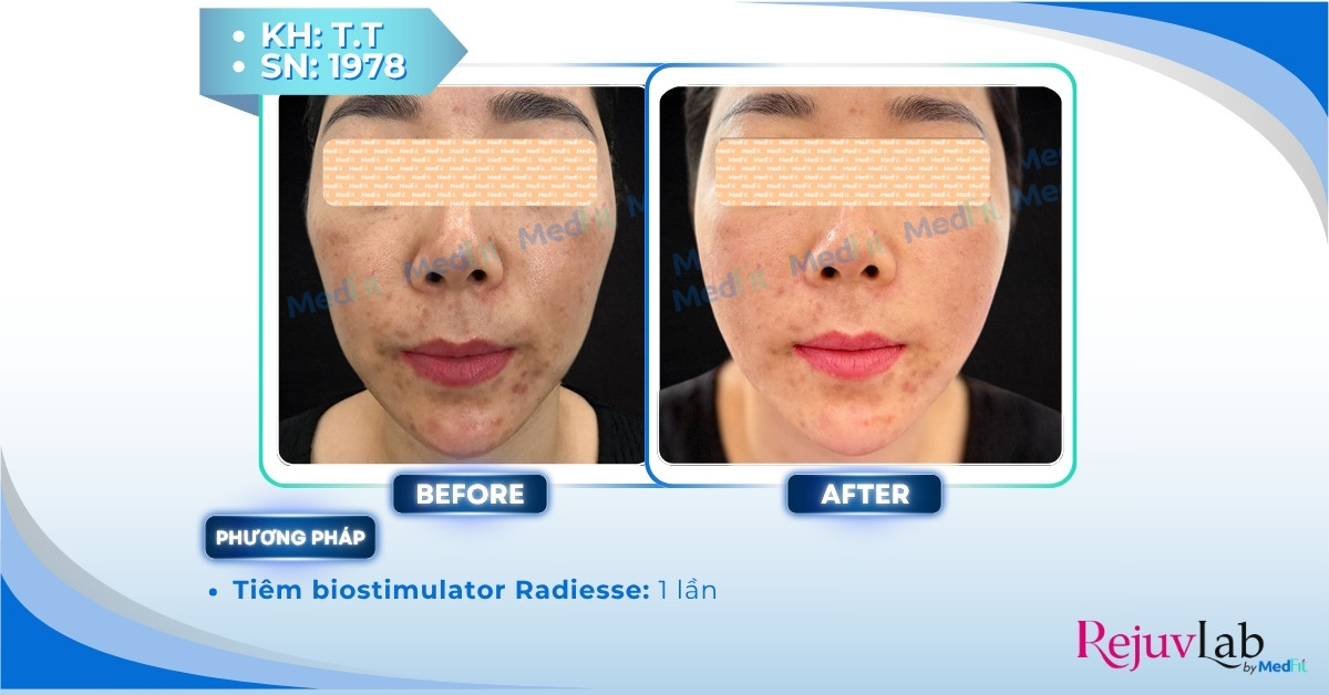 Tất cả những gì bạn cần biết về skin booster trong trẻ hóa và tái tạo làn da 22 ca lâm sàng tiêm radiesse tại medfit