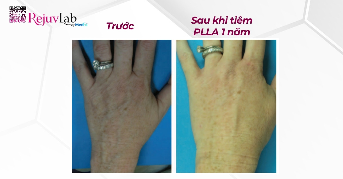 ca lâm sàng tiêm trẻ hoá bàn tay bằng plla, hình ảnh được trích từ nghiên cứu