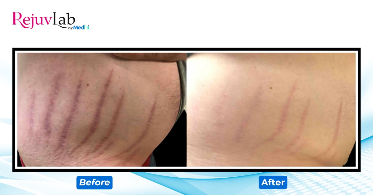 ca lâm sàng trị rạn da tại medfit