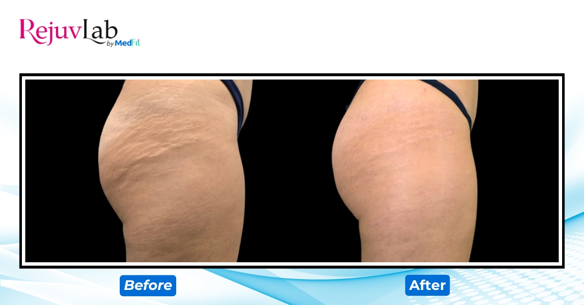 ca lâm sàng trị rạn da trắng tại medfit