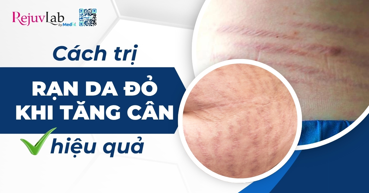 cách trị rạn da đỏ khi tăng cân hiệu quả