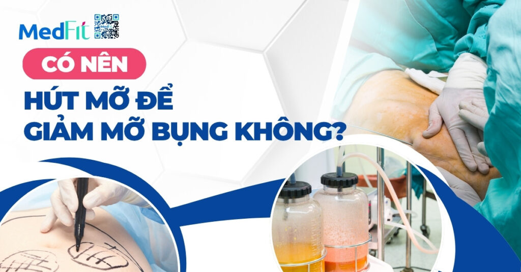 có nên hút mỡ để giảm mỡ bụng không