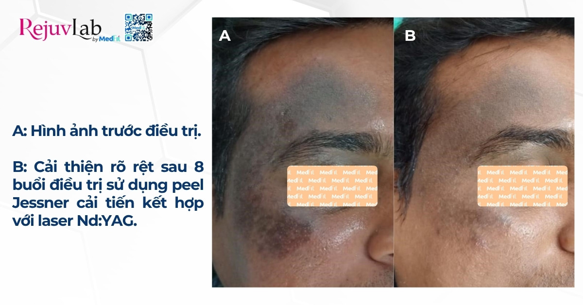 hiệu quả làm mờ bớt ota trên má phải của một bệnh nhân nam 24 tuổi
