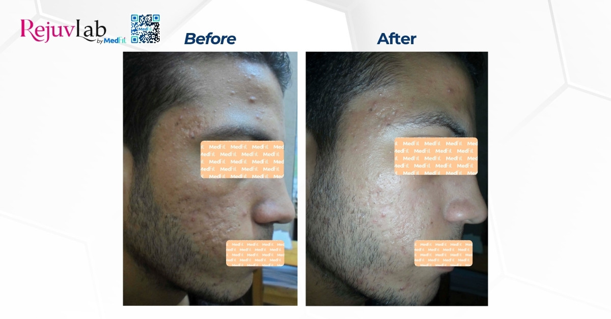 hiệu quả peel trị sẹo trong nghiên cứu