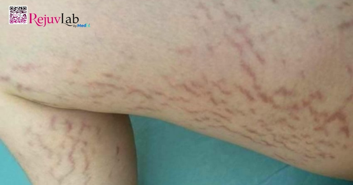 hình minh hoạ bị rạn da màu đỏ ở bắp chân