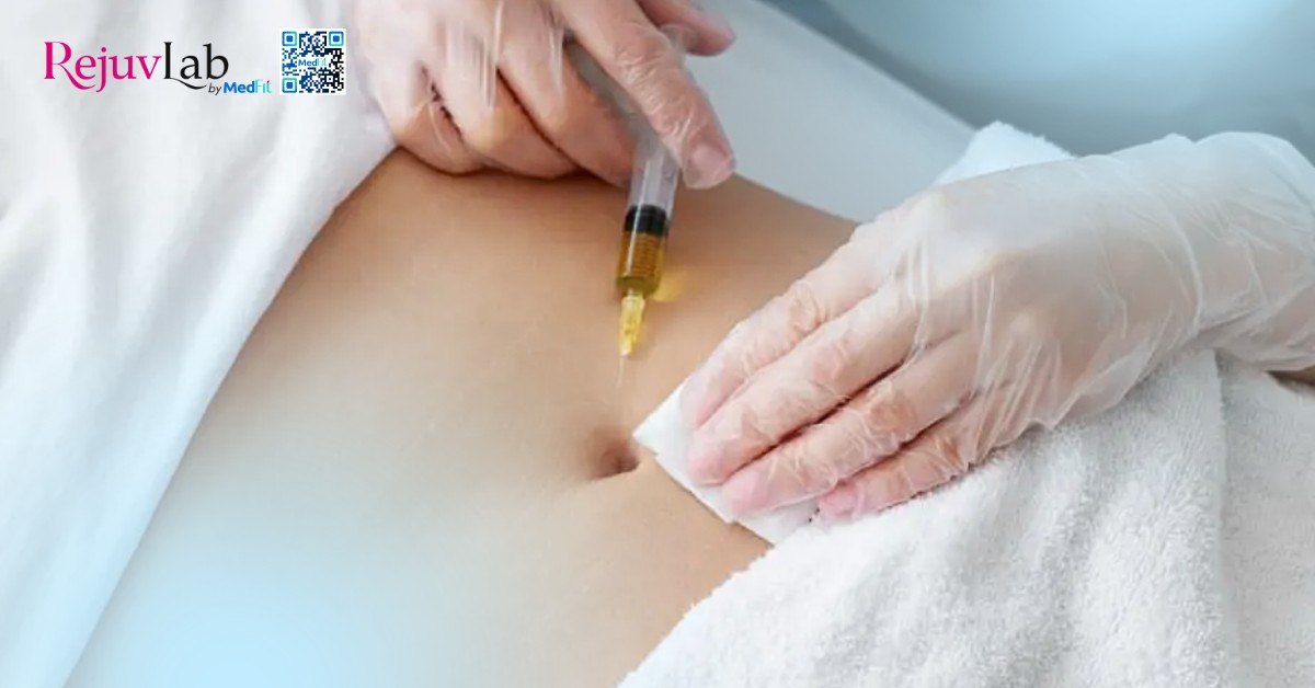 Rạn da tuổi dậy thì có hết không? Sự thật và cách điều trị 7 hình minh hoạ các phương pháp tiêm trị rạn