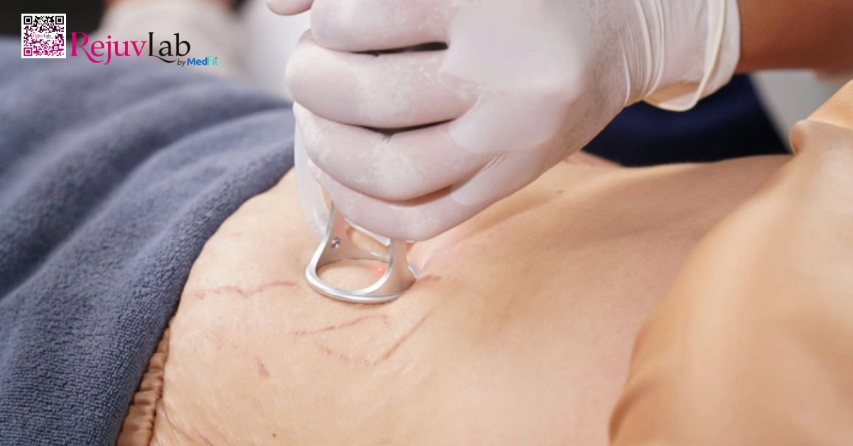 hình minh họa laser trị rạn da