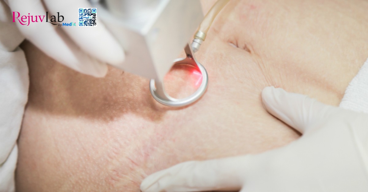 Rạn da tuổi dậy thì có hết không? Sự thật và cách điều trị 8 hình minh hoạ laser trị rạn da