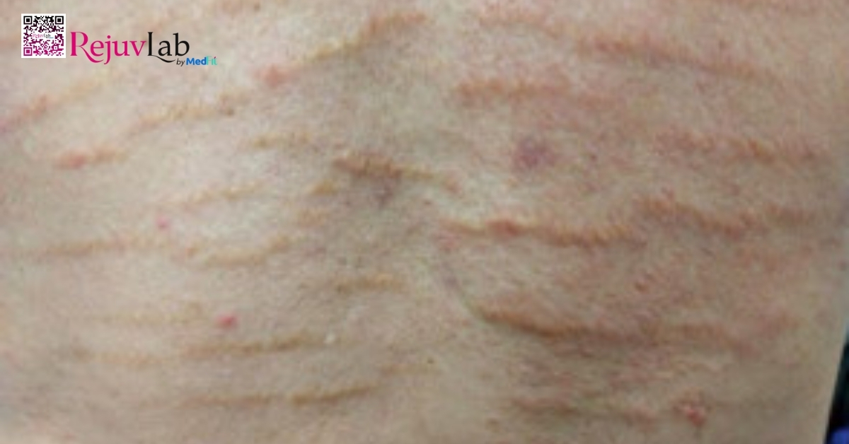 nguyên nhân gây rạn da và các cách điều trị hiệu quả nhất hiện nay