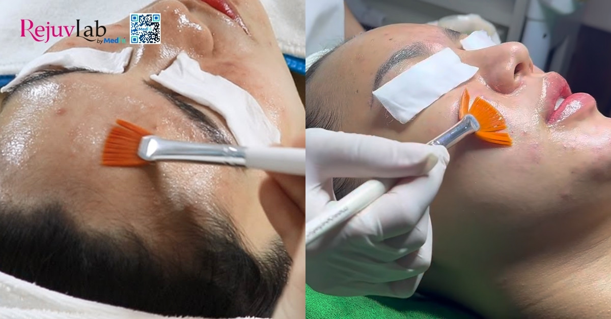 hình minh hoạ peel da hóa học