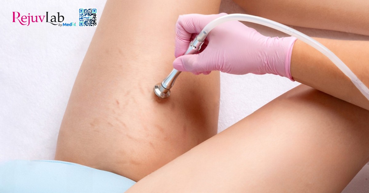 Rạn da tuổi dậy thì có hết không? Sự thật và cách điều trị 11 hình minh hoạ phương pháp mài da vi điểm