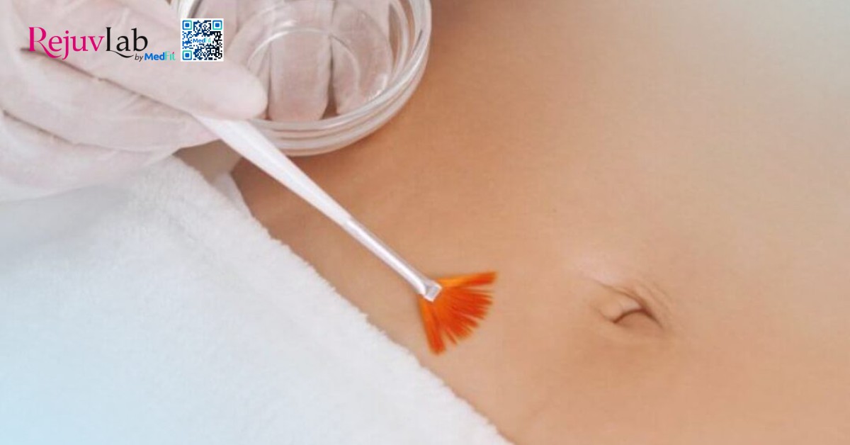 Rạn da tuổi dậy thì có hết không? Sự thật và cách điều trị 9 hình minh hoạ phương pháp peel da
