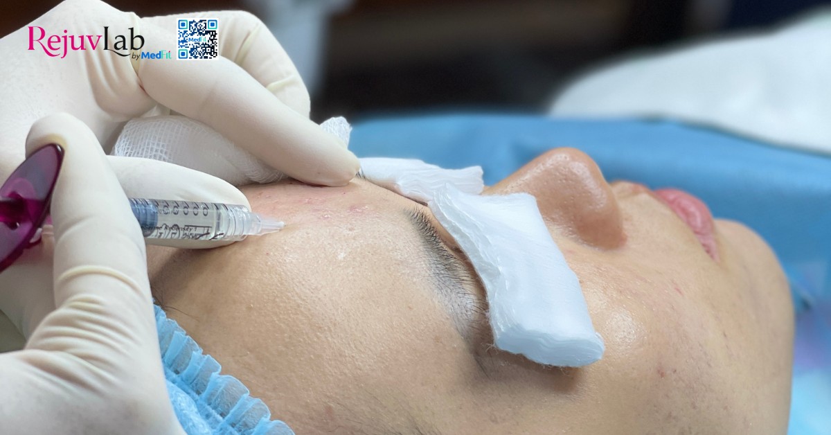 Tất cả những gì bạn cần biết về skin booster trong trẻ hóa và tái tạo làn da 23 hình minh họa tiêm meso redensity 1