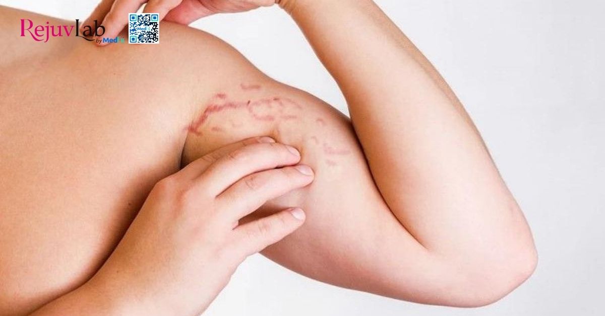 hình minh họa vết rạn da đỏ