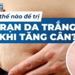 Làm thế nào để trị rạn da trắng khi tăng cân?