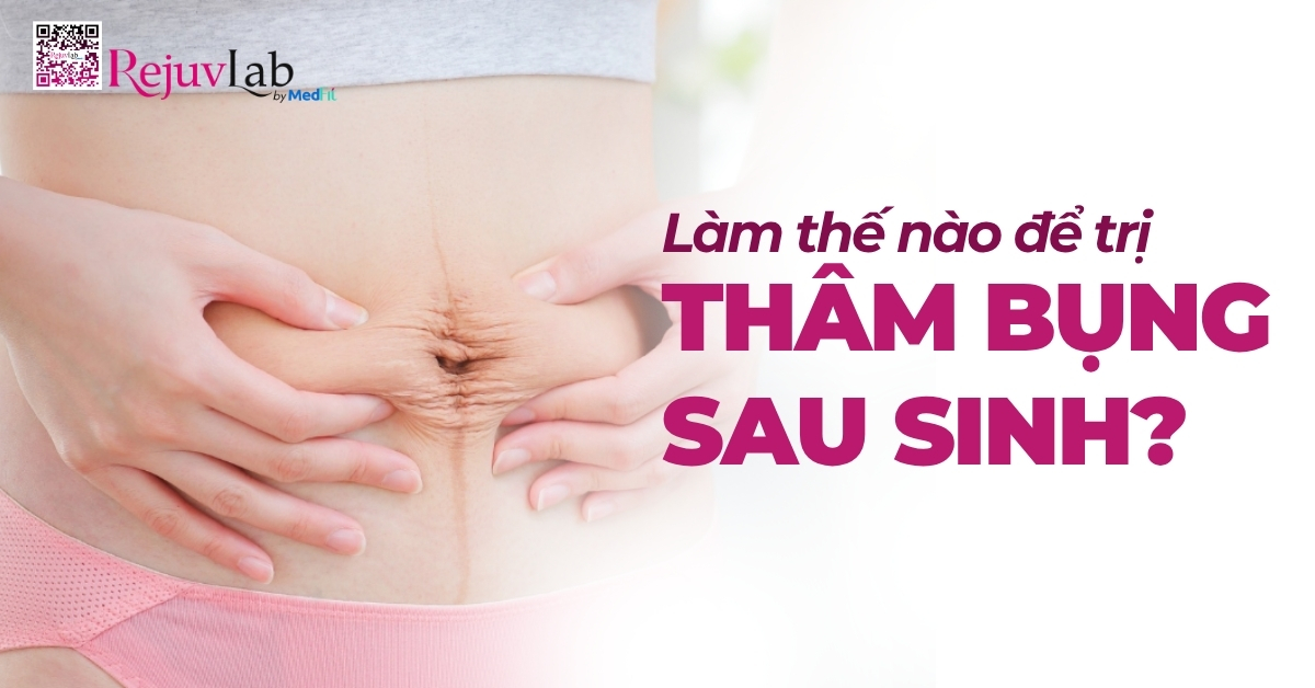 làm thế nào để trị thâm bụng sau sinh