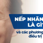 Nếp nhăn marionette (nếp nhăn khoé miệng): Làm sao để cải thiện? 4 Nếp nhăn tĩnh là gì và các phương pháp điều trị